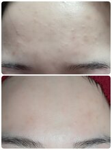 リズ ボーテ/ハーブピーリング２回の効果