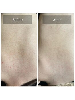 アーユルヴェーダアンドアロマエステ アユス(AYUS)/ハーブピーリング 背中