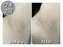 ナルシス/【脱毛】2回の変化★