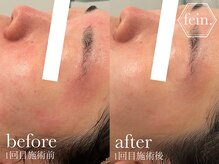 フェイン 青山店(fein.)/赤みを落ち着かせるピーリング