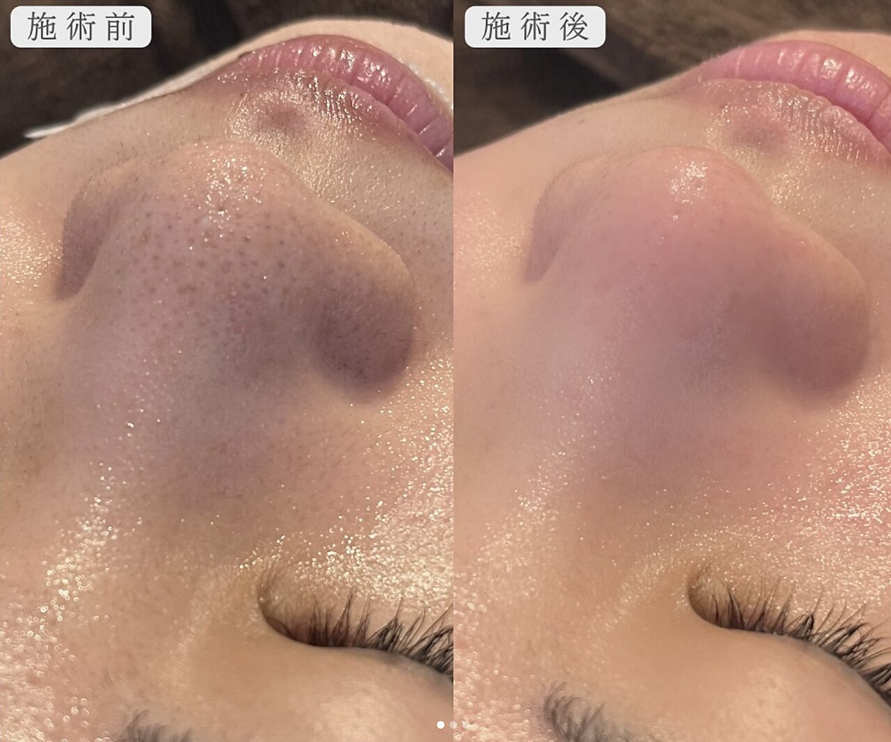 【毛穴洗浄】大バズリ中！泡パック仕上げで美肌に！ハイドロピーリング\8800