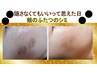 【自宅でシミケアされたい方】NEWシミケアハイドロキノン