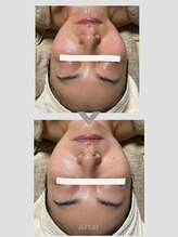 ゆりの花/フェイシャル90分+クレイパック