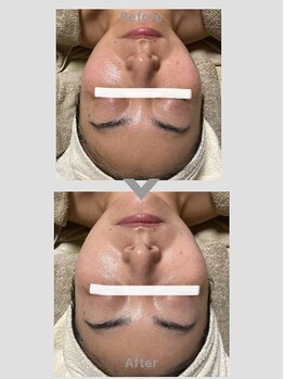 ゆりの花/フェイシャル90分+クレイパック