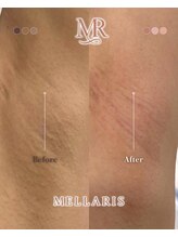 アンテサロン 関内店(Antesalon)/男女可能◎黒ずみ改善♪