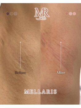 アンテサロン 関内店(Antesalon)/男女可能◎黒ずみ改善♪