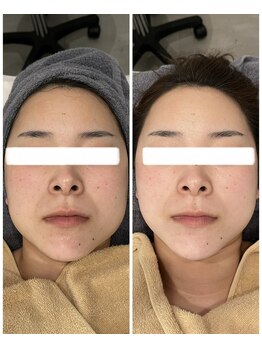 イル 名取店(iru)/糸式リフトアップフェイシャル