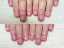 グラシナ なんば店/深爪/自爪育成/フィルイン