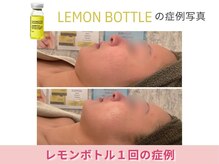 アメリイ 百合ヶ丘 新百合ヶ丘(Amerii)/【20代レモンボトル】1回の結果