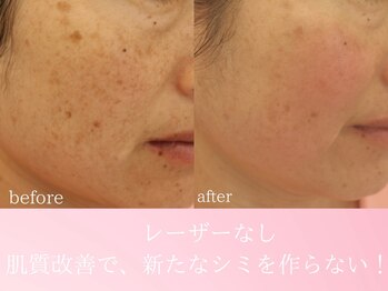 ファニービー 茨木店/50代 シミ 8ヶ月で改善