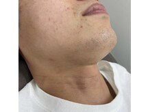 ナノハナ/鹿沼市の全身脱毛のナノハナ