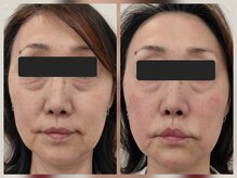 整骨院トリデ(整骨院TORIDE)/目元・口元・ほうれい線