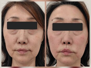 整骨院トリデ(整骨院TORIDE)/目元・口元・ほうれい線