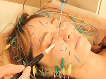 テンジンはり灸院(tenjinはり灸院)/バイオハリフォースイオン導入