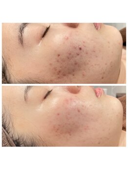 ヴィアス(VIAS)/プラズマフェイシャル　5回目