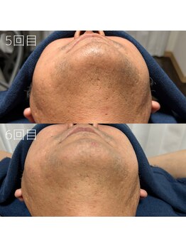 カナウ(KANAU)/ヒゲ脱毛（40代後半男性）継続中