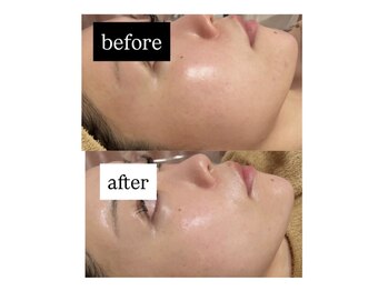 スールボーテ(soeur beaute)の写真/《毛穴・くすみ・ごわつきに◎》韓国発ララピールで輝く美肌へ！ダウンタイム無しで叶える、憧れのお肌に☆