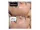 スールボーテ(soeur beaute)の写真/《毛穴・くすみ・ごわつきに◎》韓国発ララピールで輝く美肌へ！ダウンタイム無しで叶える、憧れのお肌に☆