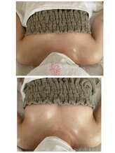 サロン ド チョコ(SALON DU CHOCO)/【バストアップ】症例