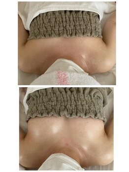 サロン ド チョコ(SALON DU CHOCO)/【バストアップ】症例