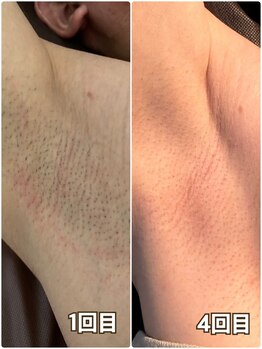 メンズ シンバ(SIMBA)/☆ ビフォーアフター ☆