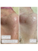エイル ビューティ ホヌ(EIL beauty Honu)/ハイドラ&エアバリ+美容液導入