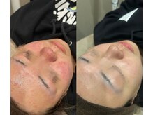 #美容革命ラボ 福岡春吉店/肌経過【天神春吉】