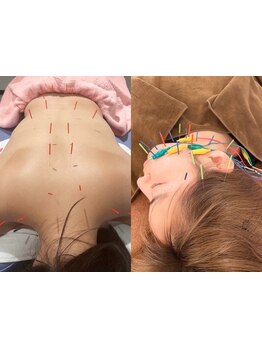 鍼灸施術を受けたい