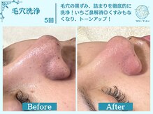 フローフシ∞/【毛穴洗浄】毛穴の黒ずみ解消