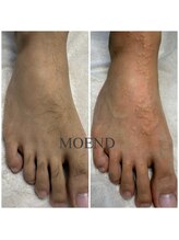 モエンド(MOEND)/足の甲指