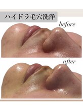 スカイ(sky)/毛穴、洗顔だけじゃ無理