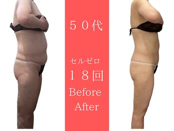 ムーン 高崎店(MOON)/セルゼロ痩身3ヶ月