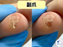 プラスワンフット 本厚木(+1 Foot)/痛い・引っかかる・邪魔な副爪に
