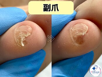 プラスワンフット 本厚木(+1 Foot)/痛い・引っかかる・邪魔な副爪に
