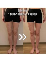 アンドアップ(and up)/【痩身】脂肪冷却