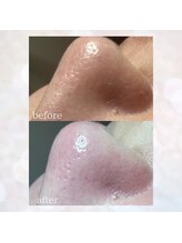 ビスイ 恵比寿(Bisui)/毛穴洗浄/毛穴黒ずみ/毛穴ケア