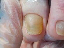 爪切り屋 足楽/剥離爪◆50代女性 (before)