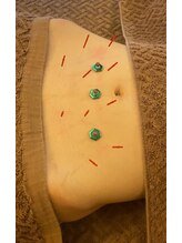 リノア鍼灸院(LINOA)/美腸鍼