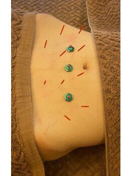 リノア鍼灸院(LINOA)/美腸鍼