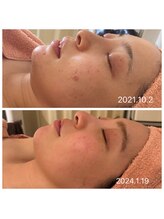 アティレ オオサカ(Attirer Osaka)/リフトアップ/小顔/ハリ/毛穴