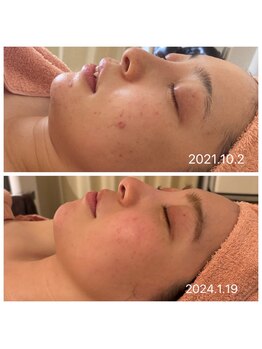 アティレ オオサカ(Attirer Osaka)/リフトアップ/小顔/ハリ/毛穴