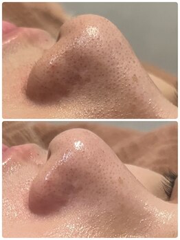 リノ(LINO)/押し出し、吸引なしの毛穴ケア