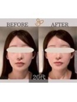 チョコバリ 錦糸町店(chocobari)/小顔×リフトアップ(美容鍼)20代