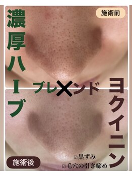 アリュール(ALLURE)/濃厚ハーブピーリング施術効果
