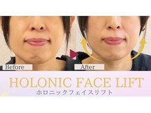 フィーカ/曖昧フェイスラインが変化！