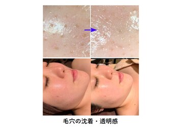 ココリッチ(KoKoRichi)/【バイオピーリング】/毛穴