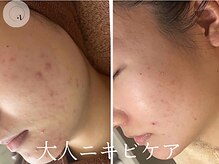 LUNEA/《症例》ニキビケア