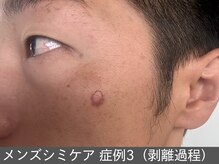 オアシスラグーン(OASIS LAGOON)/メンズシミケア（症例3 過程）
