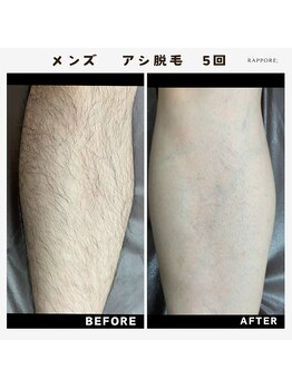 ラポール(rappore;)/メンズ脚脱毛