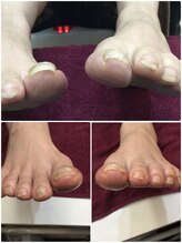 シャンネイルケアサロン(Shan Nail caresalon)/足爪の食い込みや違和感に